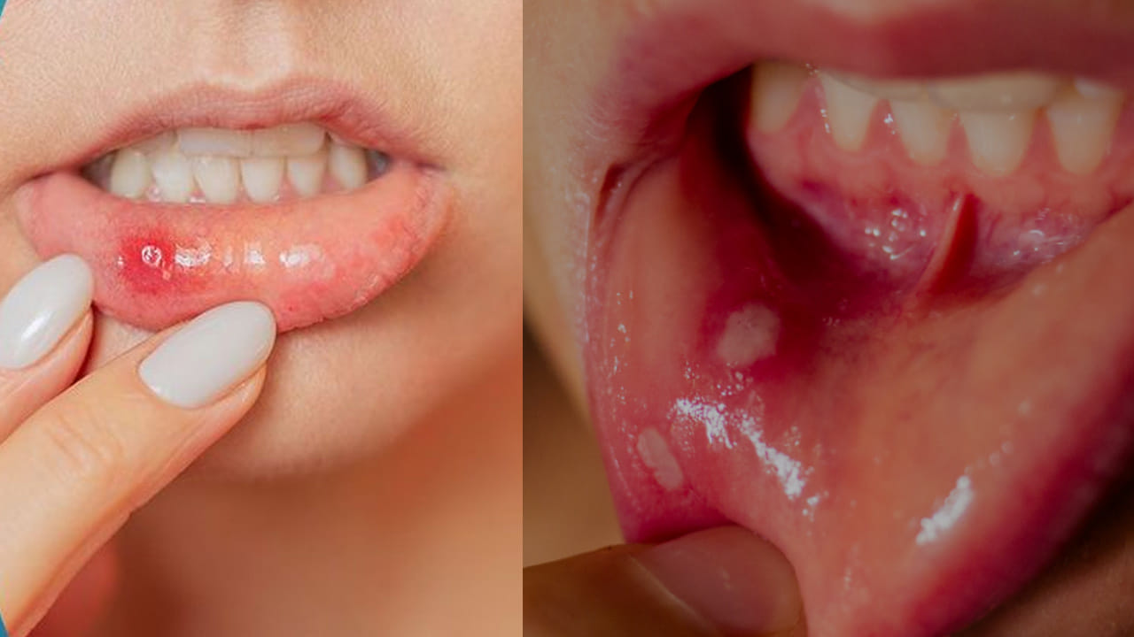 Home Remedies For Mouth Ulcers