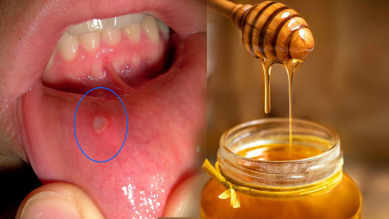 తేనె (Honey) - సహజమైన హీలర్: తేనెలో అద్భుతమైన యాంటీ ఇన్ఫ్లమేటరీ, యాంటీ బ్యాక్టీరియల్ గుణాలు ఉన్నాయి. నోటి పూత ఉన్న ప్రదేశంలో కొద్దిగా స్వచ్ఛమైన తేనెను రాయండి. ప్రారంభంలో కొద్దిగా మంటగా అనిపించినప్పటికీ, ఇది పుండ్ల వాపును తగ్గించి, చర్మాన్ని త్వరగా కోలుకునేలా చేస్తుంది. తేనె నోటిలో లాలాజలాన్ని ఊరేలా చేసి తేమను కాపాడుతుంది.