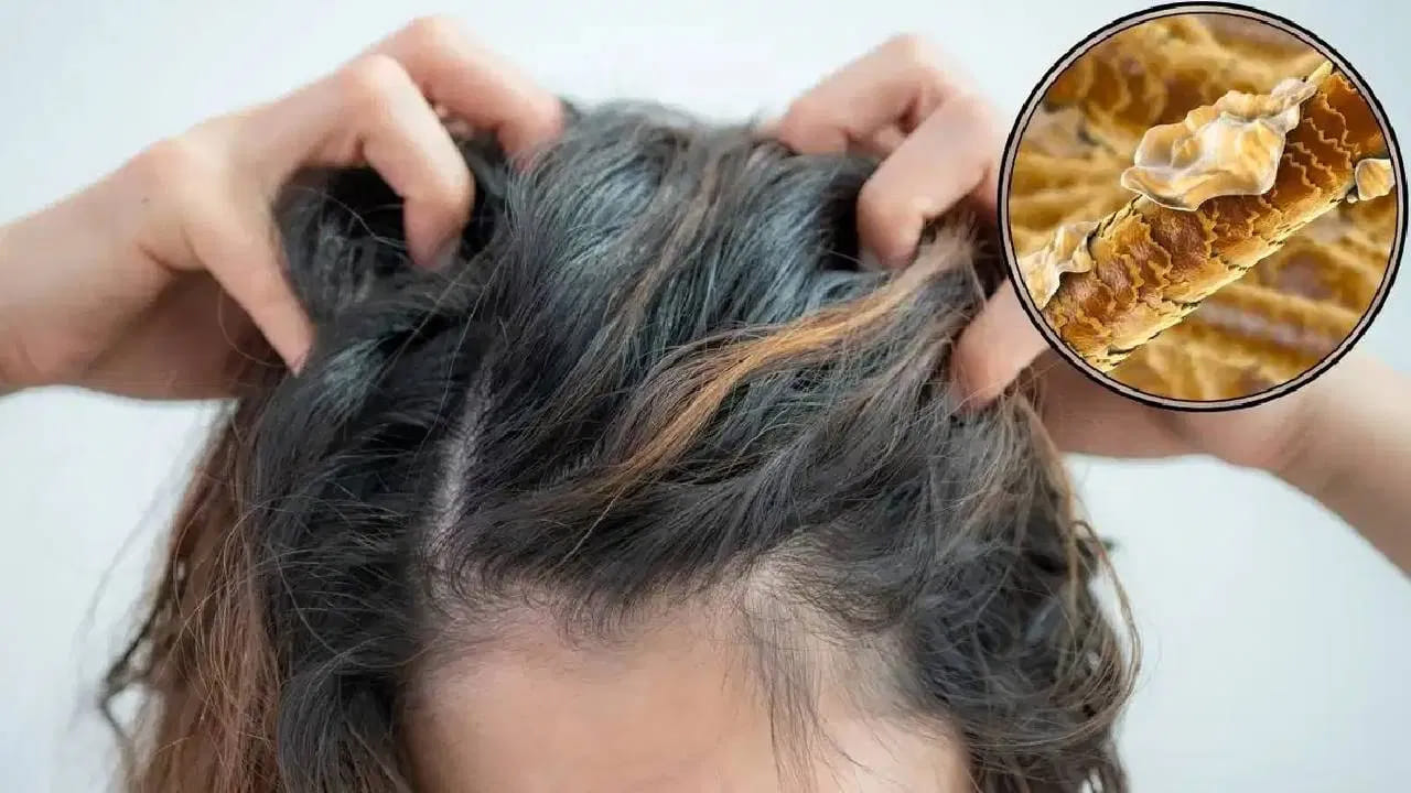 చుండ్రు చుక్కలు చూపిస్తుందా.. ఈ అలవాట్లు మార్చుకోకపోతే జుట్టు ఊడిపోవడం ఖాయం.. | How to Stop Severe Dandruff and Hair Loss: Ultimate Scalp Care Guide