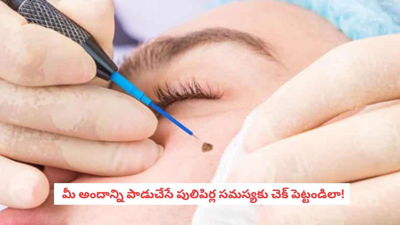 Skin Warts: రూపాయి ఖర్చు లేకుండా పులిపిర్లను రాల్చేసే చిట్కాలు.. మీ అందాన్ని పాడుచేసే ఆ సమస్యకు చెక్