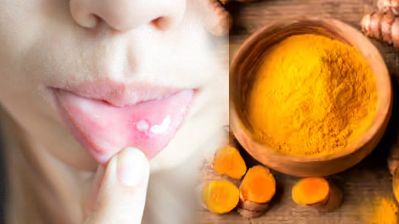 పసుపు పేస్ట్ (Turmeric) - క్రిమినాశని: పసుపు ఒక అద్భుతమైన యాంటీసెప్టిక్. ఒక చెంచా పసుపు పొడిలో కొద్దిగా నీరు లేదా గ్లిసరిన్ కలిపి చిక్కటి పేస్ట్లా తయారుచేయండి. ఈ పేస్ట్ను నోటిలోని పుండ్లపై రాసి, ఒక 10 నుండి 15 నిమిషాల పాటు అలాగే ఉంచండి. ఆ తర్వాత గోరువెచ్చని నీటితో నోటిని శుభ్రం చేసుకోండి. పసుపులోని కర్కుమిన్ అనే సమ్మేళనం ఇన్ఫెక్షన్ను నయం చేయడంలో వేగంగా పనిచేస్తుంది.