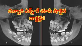 భరించలేని పంటినొప్పితో ఆస్పత్రికి పరిగెత్తిన 11ఏళ్ల బాలిక.. ఎక్స్‌రే చూసి అందరూ షాక్‌! దవడల నిండా..