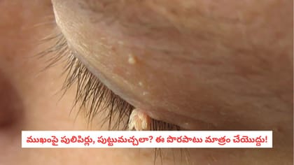 ముఖంపై పులిపిర్లు, పుట్టుమచ్చలా? ఈ పొరపాటు మాత్రం చేయొద్దు!