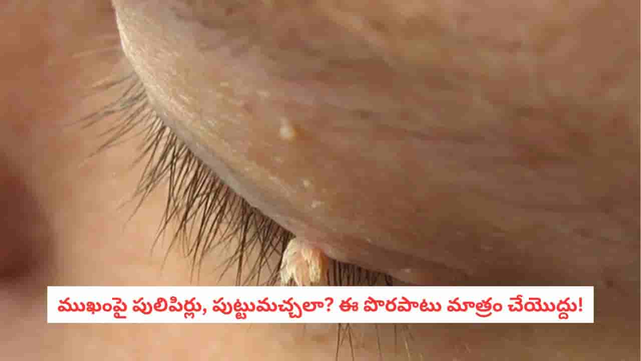 Warts Removal : ముఖంపై ఉన్న పులిపిర్లు పోవాలంటే.. ఇంటి చిట్కాలు కాదు, ఇదే సేఫ్ మార్గం!