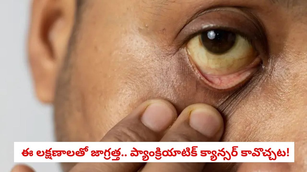 Health News: కళ్లలో పసుపు రంగు కనిపిస్తోందా?.. ఈ లక్షణాన్ని మాత్రం నిర్లక్ష్యం చేయకండి!