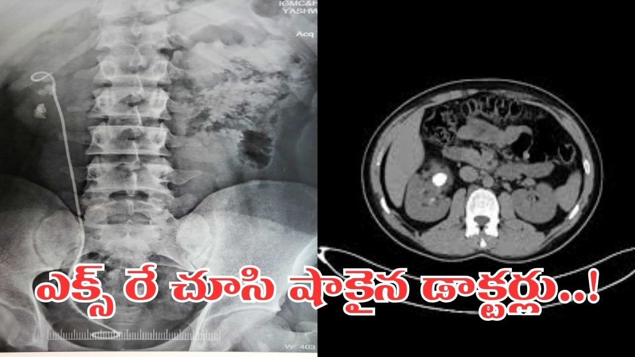 మూత్రవిసర్జనలో మంటతోపాటు విపరీతమైన నొప్పి.. ఎక్స్ రే చూసిన డాక్టర్లకు గుండెలదిరే సీన్..!