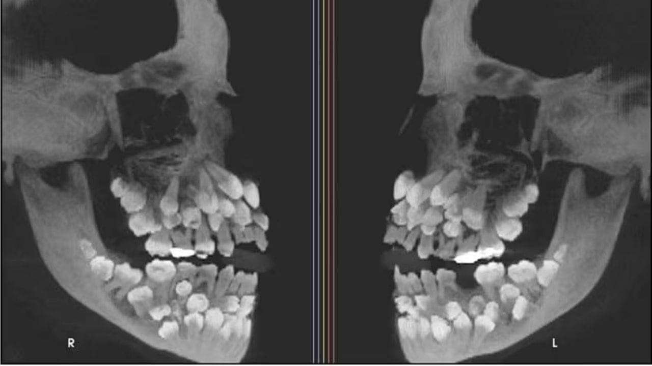 81 Teeth Brazilian Girl