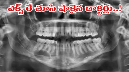పంటి నొప్పితో హాస్పిటల్‌కి వెళ్లిన బాలిక.. ఎక్స్-రే చూస్తే..