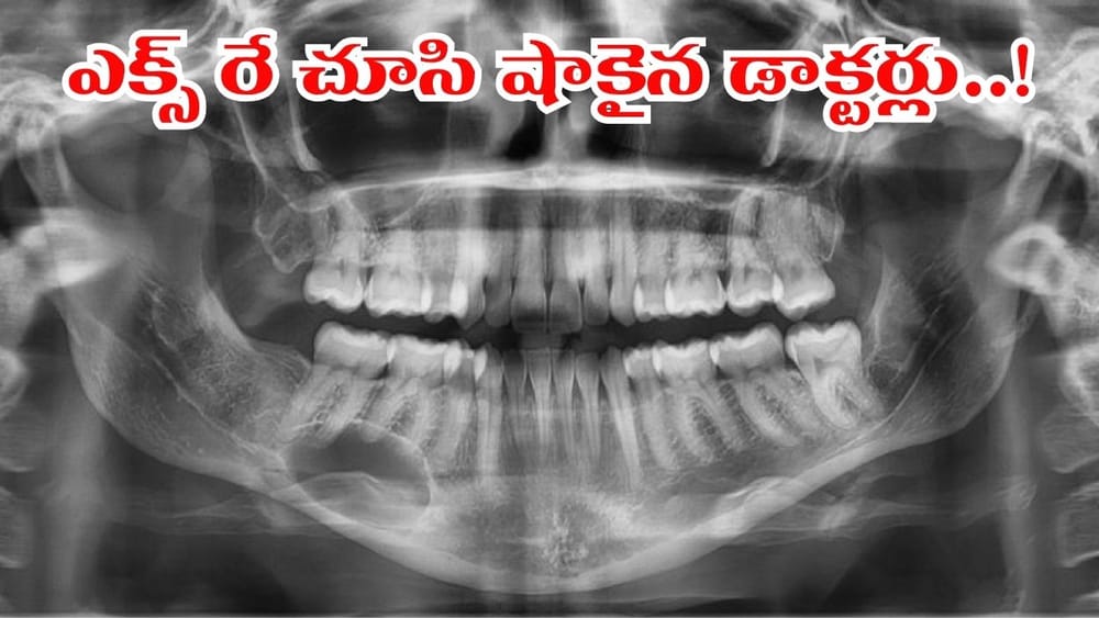 పంటి నొప్పితో హాస్పిటల్‌కి వెళ్లిన 11 ఏళ్ల బాలిక.. ఎక్స్-రే చూసిన డాక్టర్ల గుండె గుభేల్..!