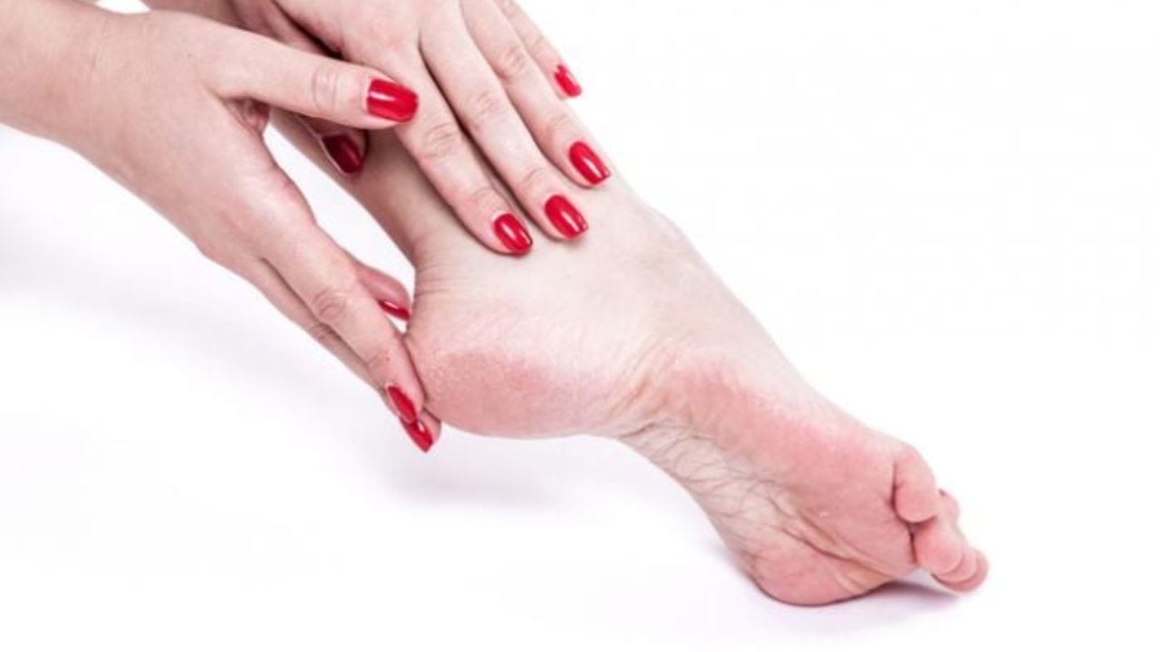 Cracked Heels Home Remedies (1)