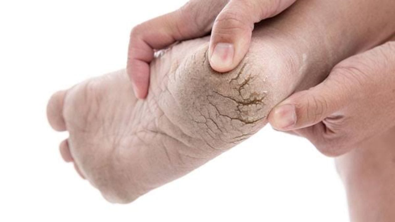 Cracked Heels Home Remedies (2)