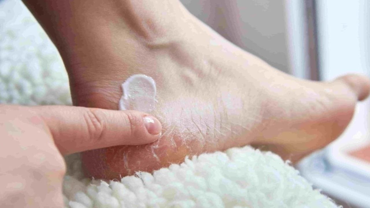 Cracked Heels Home Remedies