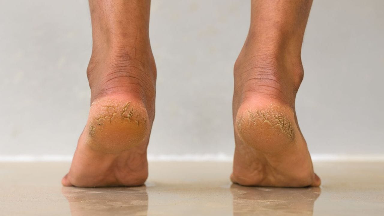Cracked Heels Home Remedies