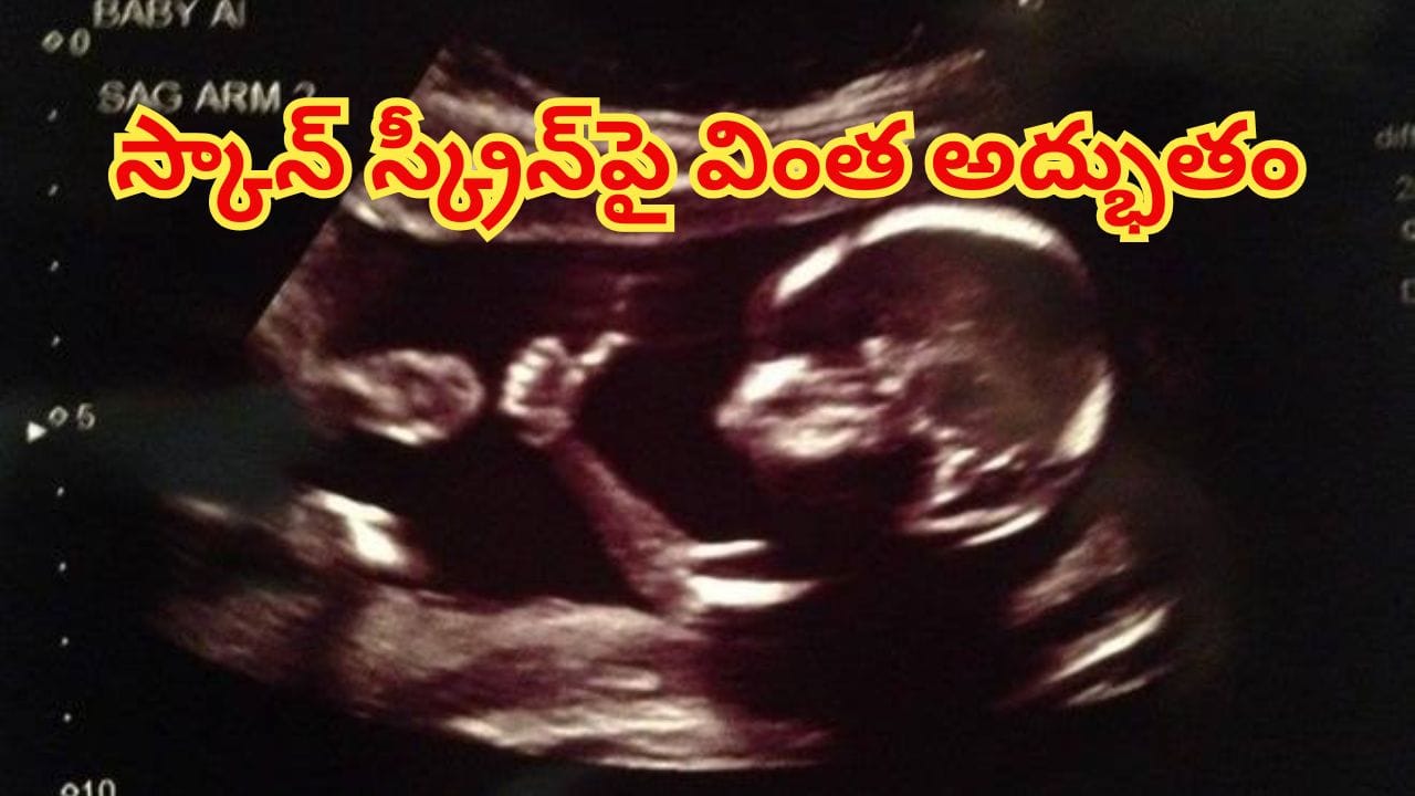 అమ్మా నేను బాగున్నాను, భయపడకు..తల్లి కడుపులో నుంచే థంబ్స్ అప్ చూపించిన పాప! కట్‌చేస్తే..