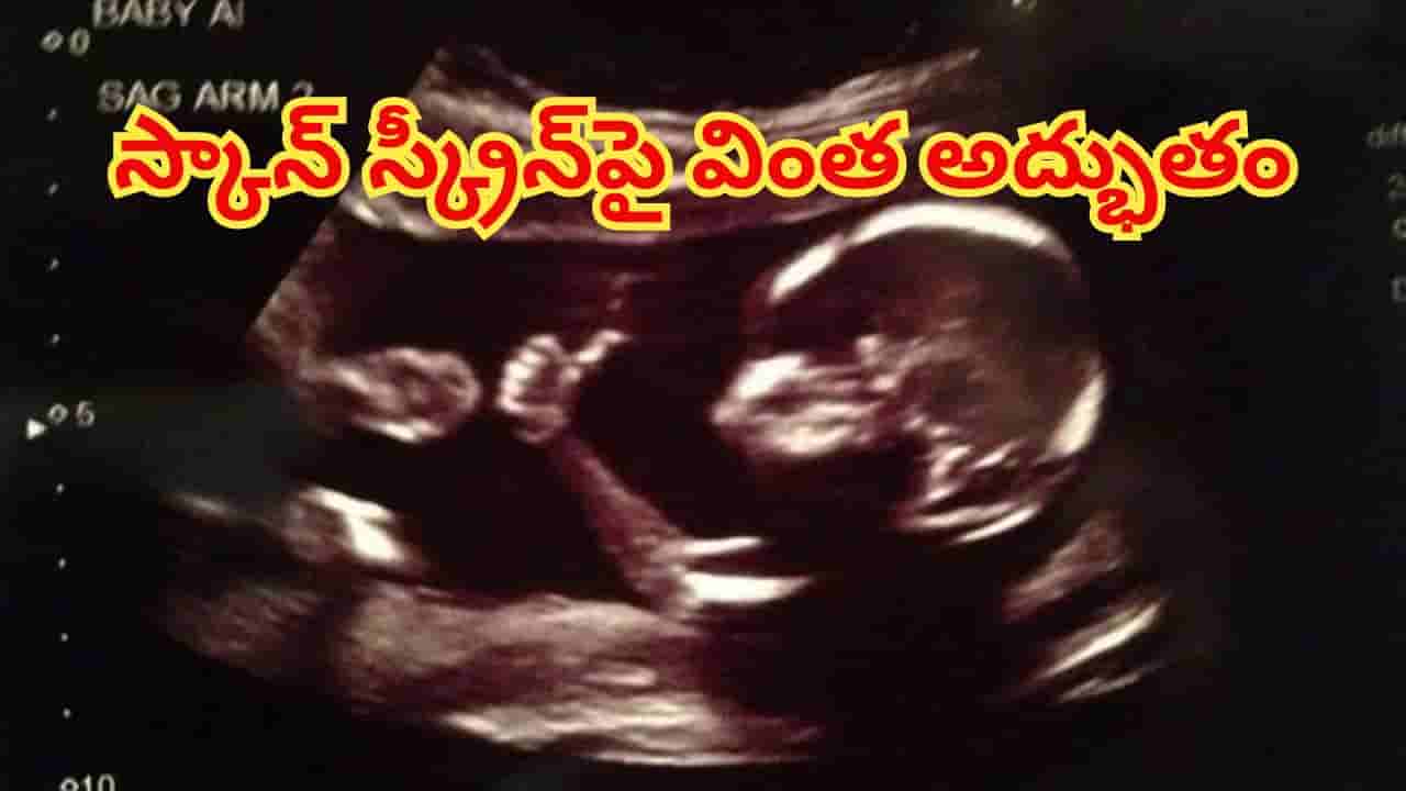 అమ్మా నేను బాగున్నాను, భయపడకు..తల్లి కడుపులో నుంచే థంబ్స్ అప్ చూపించిన పాప! కట్చేస్తే..