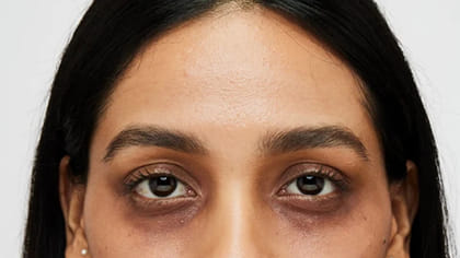 కళ్ల కింద డార్క్ సర్కిల్స్ మటుమాయం అవ్వాలంటే..?