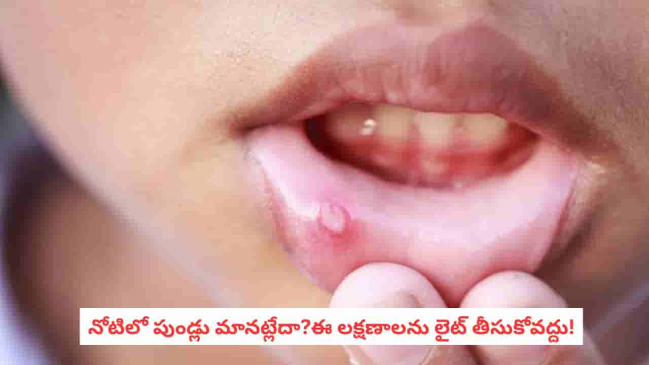 Mouth Sores: నోటి పూతేగా అని లైట్ తీసుకుంటున్నారా? ఈ లక్షణాలను అస్సలు నిర్లక్ష్యం చేయొద్దు!