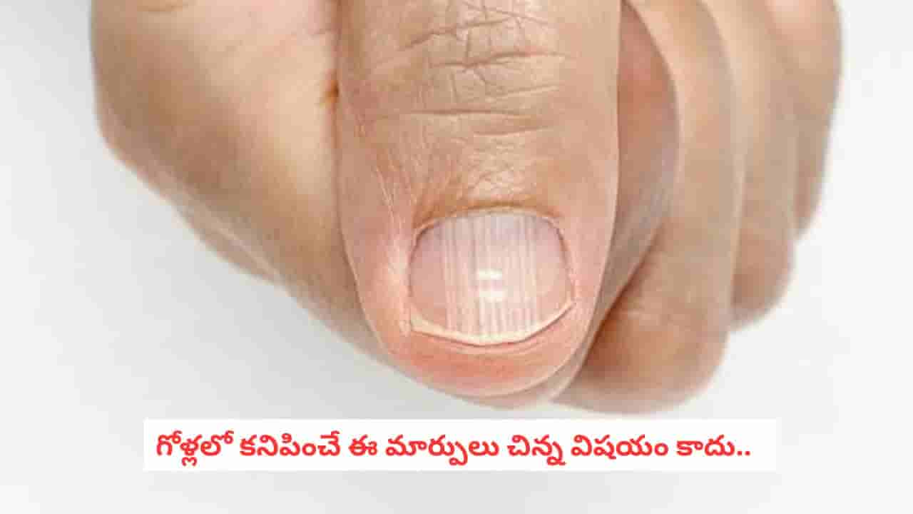 Nail Changes: గోళ్లు ఇలా మారుతున్నాయా? శరీరంలో ఏదో సమస్య ఉందని చెప్పే సంకేతాలు ఇవే!