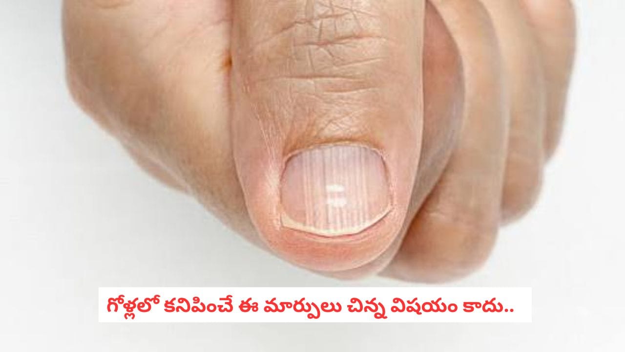 Nail Changes: గోళ్లు ఇలా మారుతున్నాయా? శరీరంలో ఏదో సమస్య ఉందని చెప్పే సంకేతాలు ఇవే!
