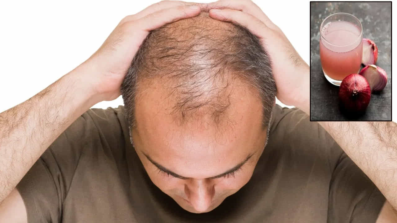 Hair Fall Remedies: ఈ రోజుల్లో జుట్టు రాలడం చాలామందిని వేధిస్తున్న సమస్య. ఒత్తిడి, పోషకాహార లోపం, హార్మోన్ల మార్పులు, వంశపారంపర్య కారణాలు వంటి అనేక అంశాలు జుట్టు రాలడానికి కారణమవుతాయి. దీంతో జుట్టు రాలడాన్ని తగ్గించుకోవడానికి చాలామంది ఇంటి చిట్కాలను ప్రయత్నిస్తున్నారు. ముఖ్యంగా ఉల్లిపాయ రసాన్ని తలకు పట్టిస్తే జుట్టు రాలడం తగ్గుతుందని, కొత్త జుట్టు పెరుగుతుందని సోషల్ మీడియాలో విస్తృతంగా ప్రచారం జరుగుతోంది. అయితే, బట్టతల ఉన్న చోట ఉల్లిపాయ రసం రాస్తే నిజంగానే కొత్త జుట్టు పెరుగుతుందా? దీనిని ఎలా ఉపయోగించాలి? తెలుసుకుందాం.