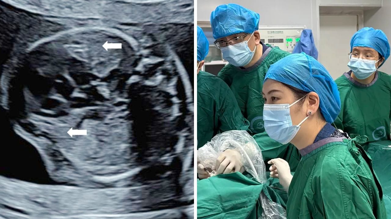 గర్భస్థ శిశువుకు ట్యూమర్.. కణితికి సూదితోనే చికిత్స.. చైనా వైద్యుల అద్భుతం!