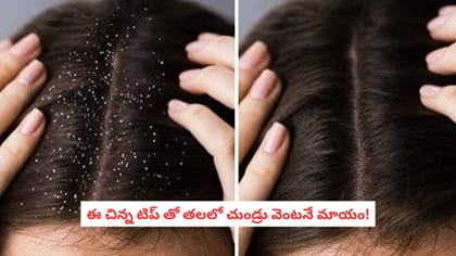 ఈ చిన్న టిప్ తో తలలో చుండ్రు వెంటనే మాయం!