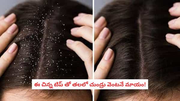 Dandruff Removal Tips: తలలో చుండ్రు సమస్య వేధిస్తోందా? ఈ చిన్న జాగ్రత్తలతో తగ్గించుకోవచ్చు!