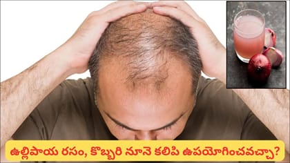 బట్టతల ఉన్న చోట ఉల్లిపాయ రసం రాస్తే కొత్త జుట్టు పెరుగుతుందా?