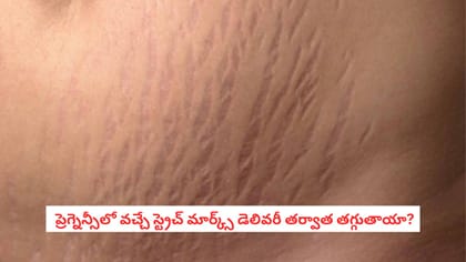  ప్రెగ్నెన్సీలో వచ్చే స్ట్రెచ్ మార్క్స్ డెలివరీ తర్వాత తగ్గుతాయా?