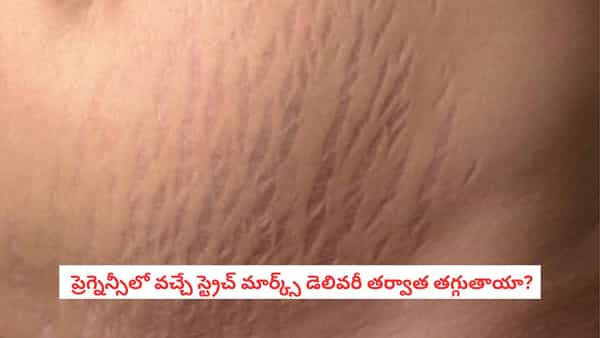 Pregnancy Stretch Marks: ప్రెగ్నెన్సీలో ఈ జాగ్రత్తలు తీసుకుంటే స్ట్రెచ్ మార్క్స్ తగ్గుతాయి!