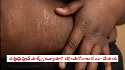  చర్మంపై స్ట్రెచ్ మార్క్స్ ఉన్నాయా? తగ్గించుకోవాలంటే ఇలా చేయండి