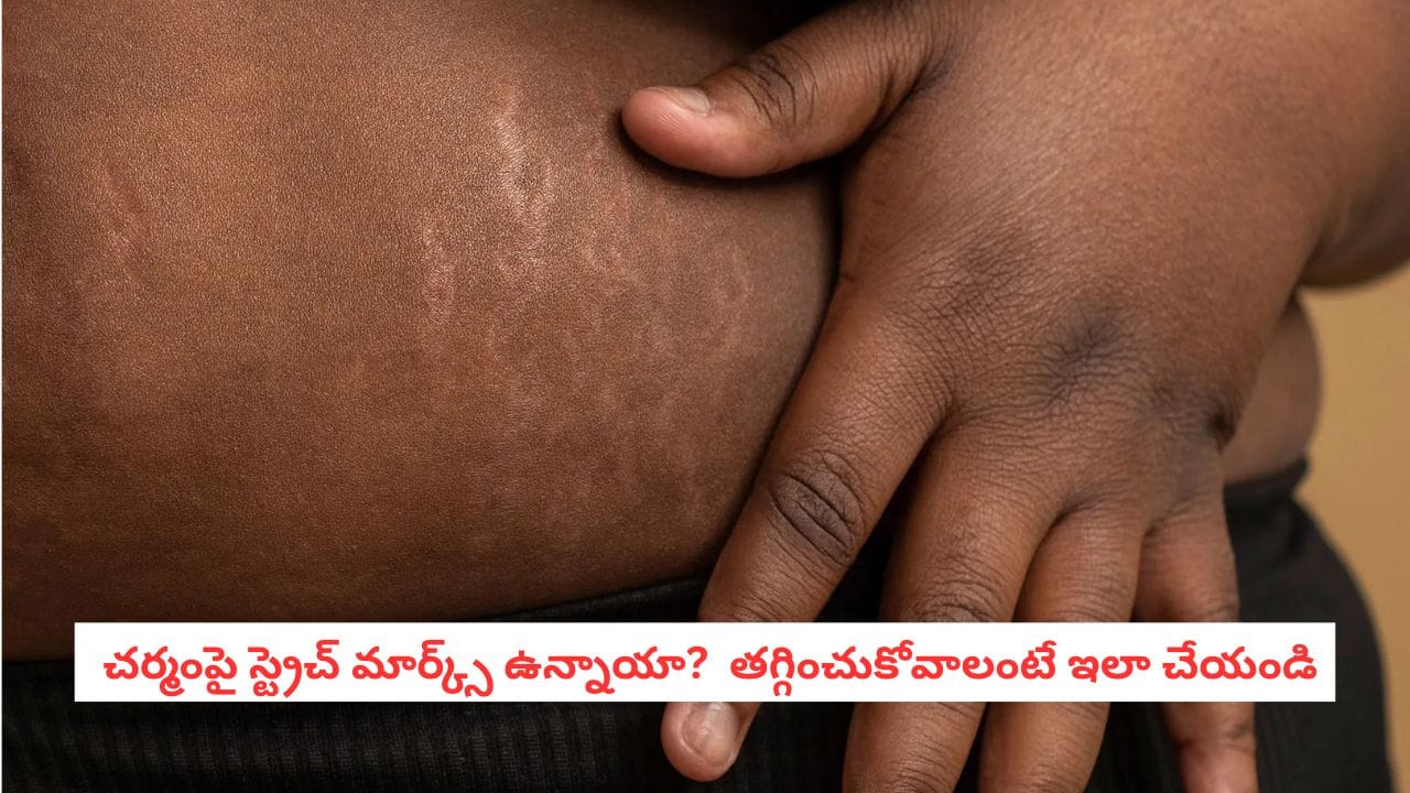 Stretch Marks: చర్మంపై ఈ చారలు కనిపిస్తున్నాయా? తగ్గించుకోవడానికి ఏం చేయాలో తెలుసుకోండి!