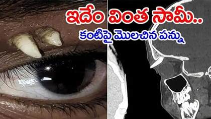 వింత ఘటన.. నోటిలో పెరగాల్సిన పన్ను కంటి పైన..!