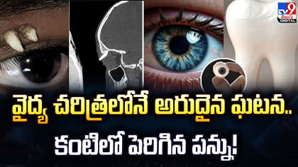 వైద్య చరిత్రలోనే అరుదైన ఘటన.. కంటిలో పెరిగిన పన్ను!
